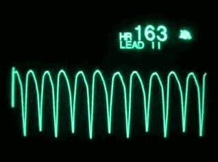 Image of anivtachpulseless.gif