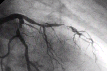 Image of angiogram.gif