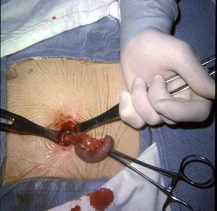 Image of appendixsurgeryacute.jpg