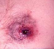 Image of chestgunshotwound.jpg