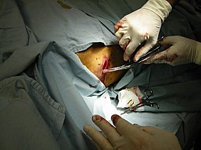Image of chesttubeinsertion.jpg