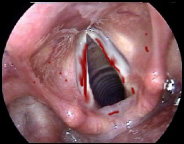 Image of intubationvocalcords2bloody.jpg