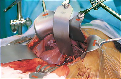 Image of liversurgery.jpg