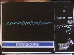 Image of vfibondatascope.jpg