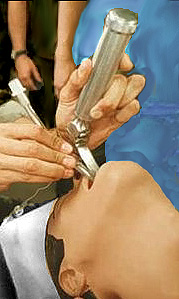 Image of intubation3.jpg